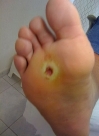hematome plantaire Fivefingers Vibram KSO EVO - hematome plantaire